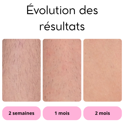 Épilateur IPL